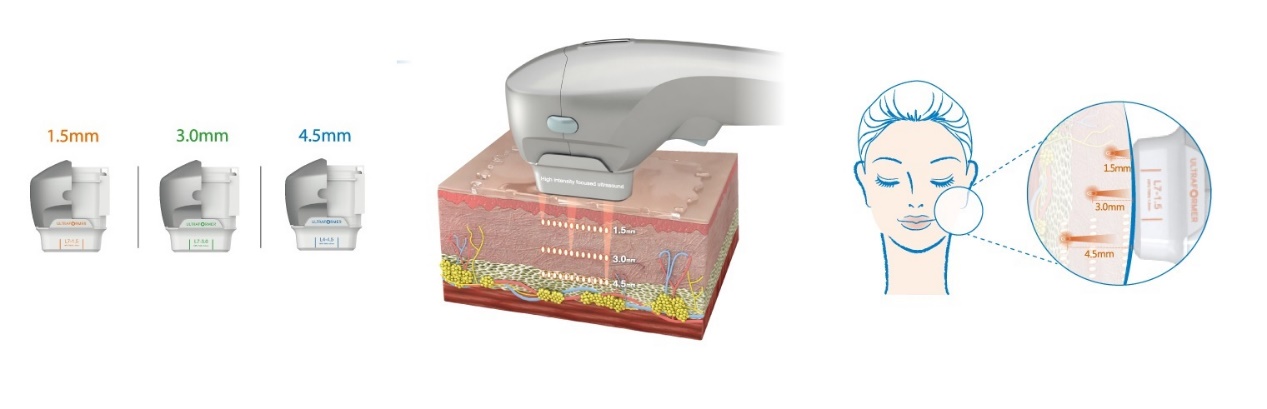 第三代海芙音波-臉部拉提：使用1.5mm、3.0mm 和 4.5mm等不同深度卡匣，透過聚焦超音波能量作用在臉部真皮層及SMAS筋膜層，刺激膠原蛋白重建新生及拉提鬆弛肌膚，減少老化現象，促進肌膚緊實，重建肌膚密度與彈力，讓您光彩煥發 | 佳飛雅醫美