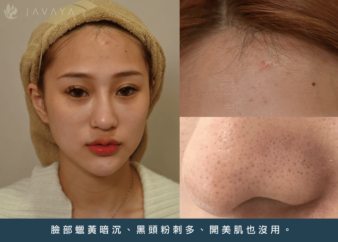 海菲秀 HydraFacial-佳飛雅醫美Javaya Clinic  蕭慕琦院長 水飛梭