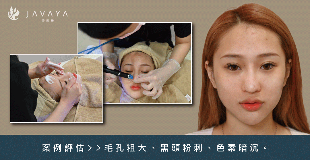 海菲秀 HydraFacial-佳飛雅醫美Javaya Clinic  蕭慕琦院長 水飛梭