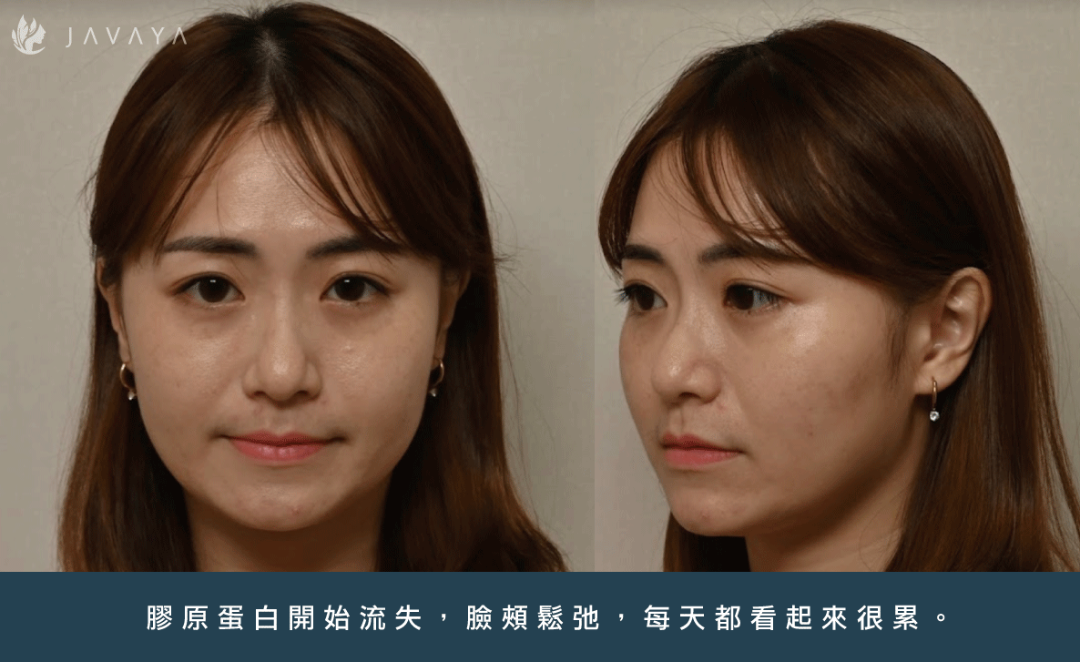 立特拉渦旋音波-素人實證-Iris:案例故事 | 佳飛雅醫美