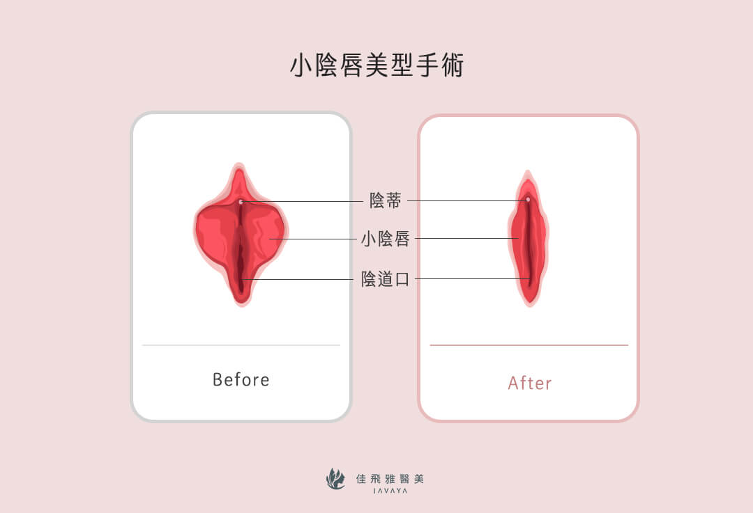 五合一生物束帶私密處緊縮術-小陰唇美型手術前後 | 佳飛雅醫美