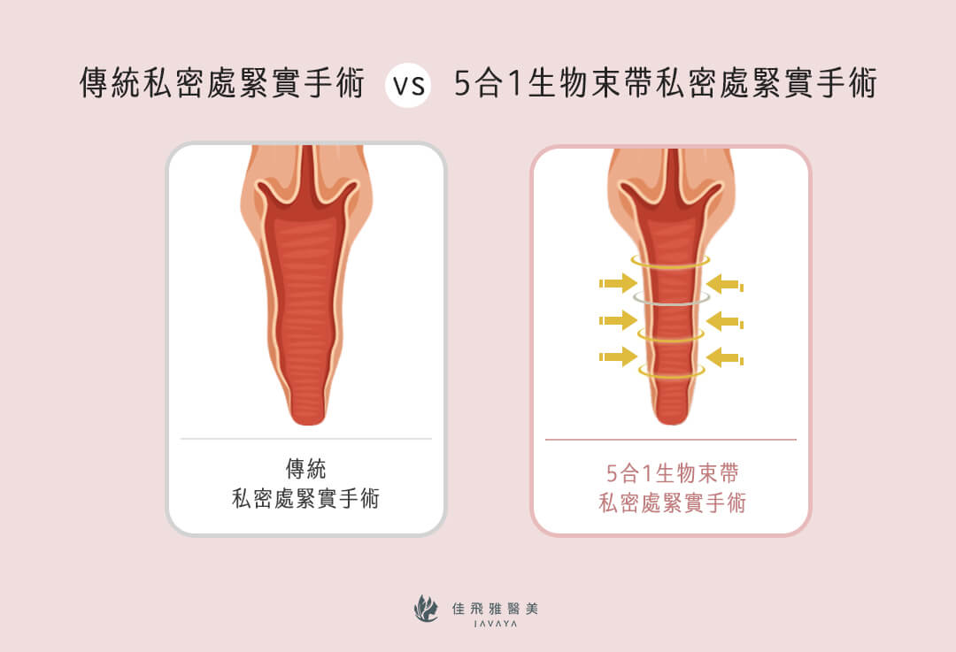 五合一生物束帶私密處緊縮術-傳統陰道緊實手術VS五合一生物束帶私密緊實術 | 佳飛雅醫美