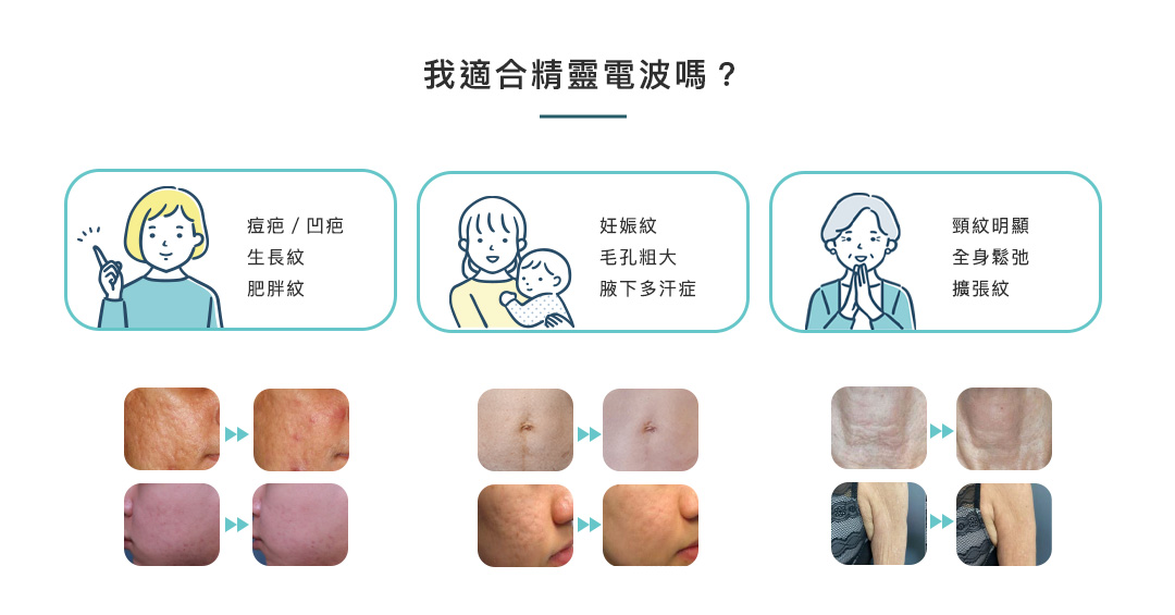 精靈電波 我適合精靈電波嗎 | 佳飛雅醫美