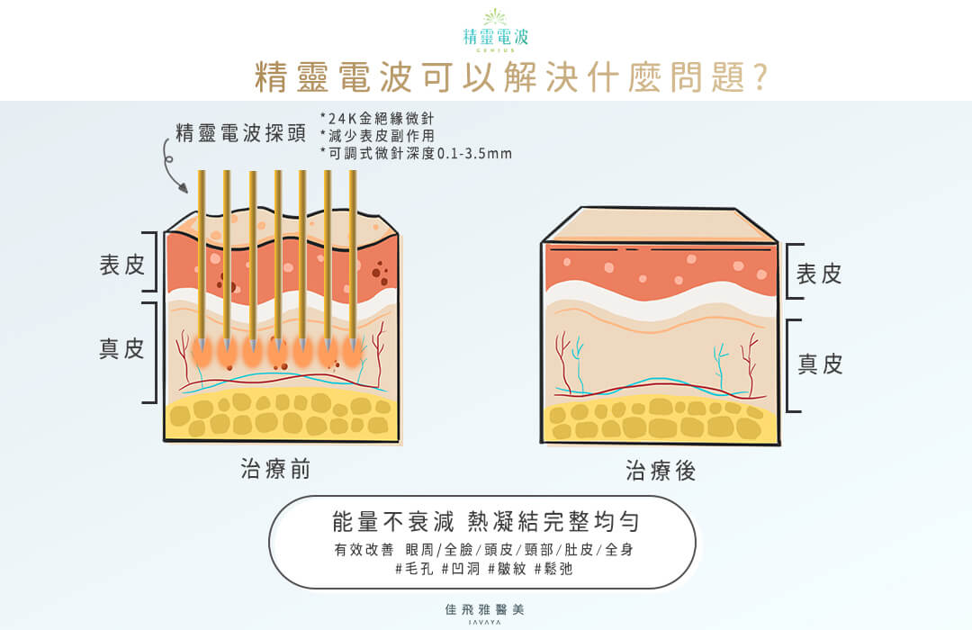 精靈電波 可以解決什麼問題? | 佳飛雅醫美 