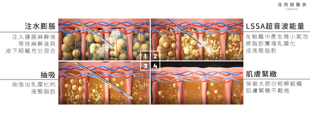 #LSSA音浪脂雕 療程步驟 | 1.注水膨脹 2.LSSA超音波能量，使脂肪乳糜化成液態脂肪 3.抽吸 4.肌膚緊緻 | 佳飛雅醫美
