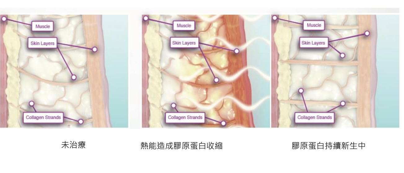 第四代鳳凰電波 作用原理 | 佳飛雅醫美