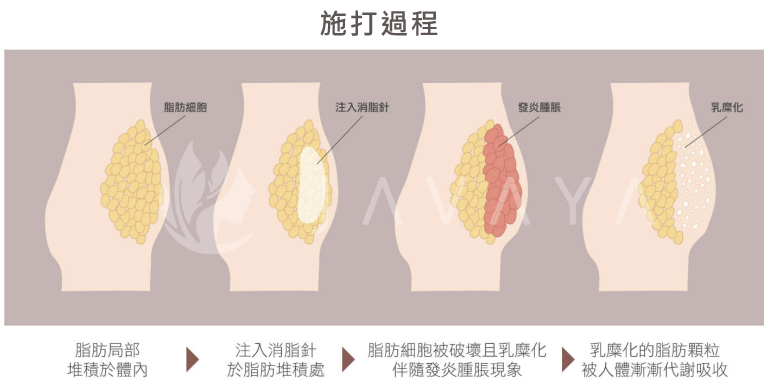 消脂針 施打作用過程 | 佳飛雅醫美