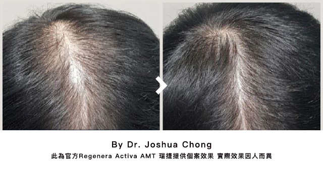 治療雄性禿不再是無解題，雄性禿治療推薦：佳飛雅醫美