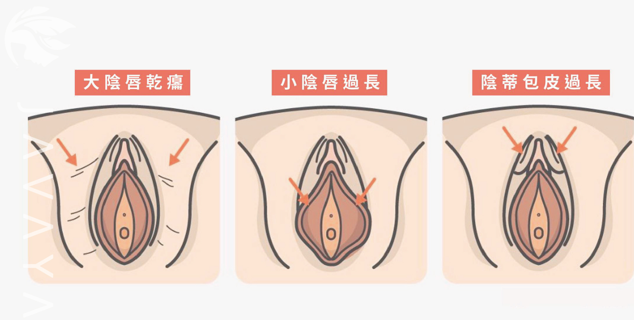 外陰部的各種問題 | 佳飛雅醫美