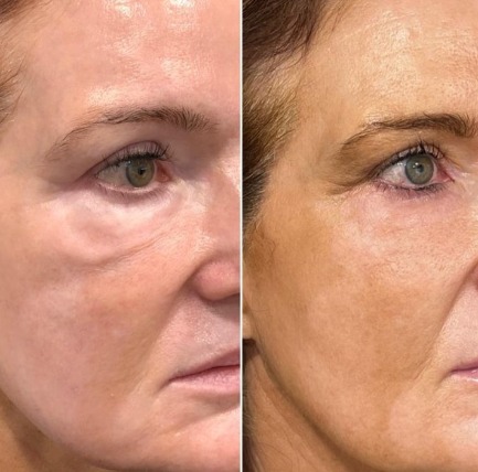 眼周電波費用,眼周電波比較,眼周電波