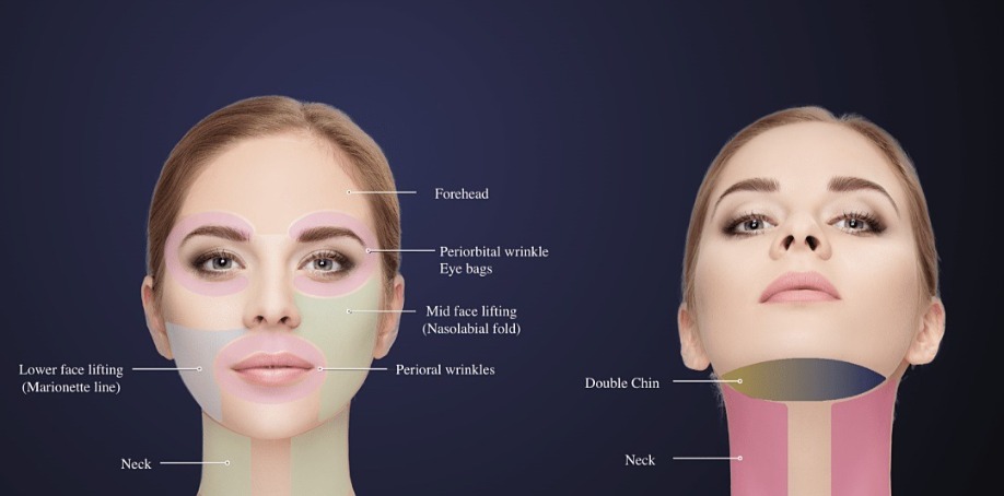 媚必提海芙音波第四代|不動刀也能精緻上鏡,輪廓更俐落!