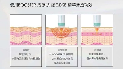 媚必提效果值得嗎?2025海芙音波第四代價格vs探頭/發數/副作用破解