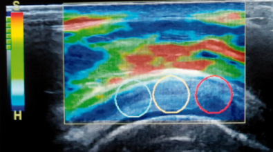 膠原蛋白增生劑