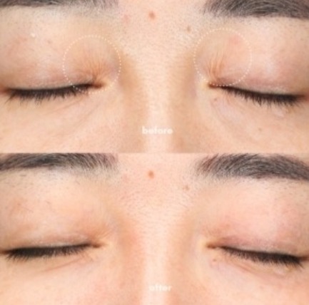 眼周電波費用,眼周電波比較,眼周電波