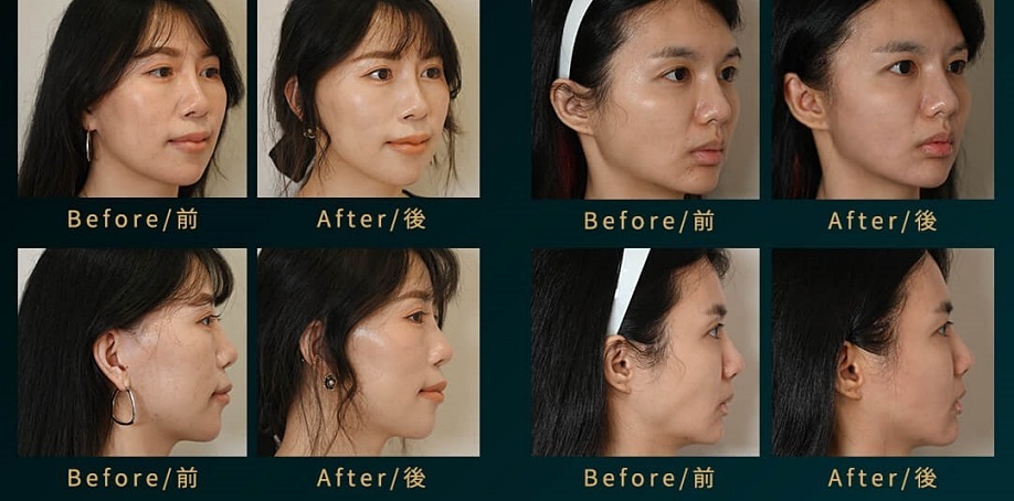 埋線原理：法令紋/嘴邊肉分區應用？線材層次與90%風險管理