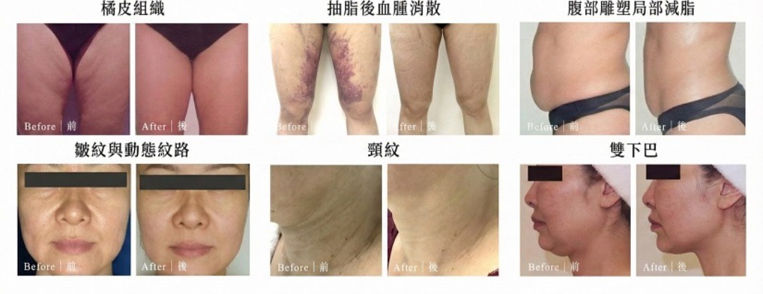 膠原蛋白增生劑