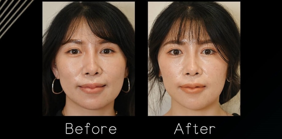 埋線原理：法令紋/嘴邊肉分區應用？線材層次與90%風險管理