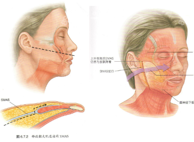 筋膜提升,無痕筋膜提升